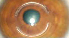 Kerarings - Intracorneal Implants