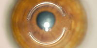 Greater Refractive Correction