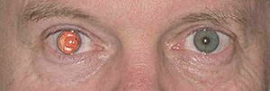Aniridia in right eye
