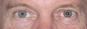 Right eye after implantation with Artificial Iris