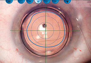 Extended Fundus View